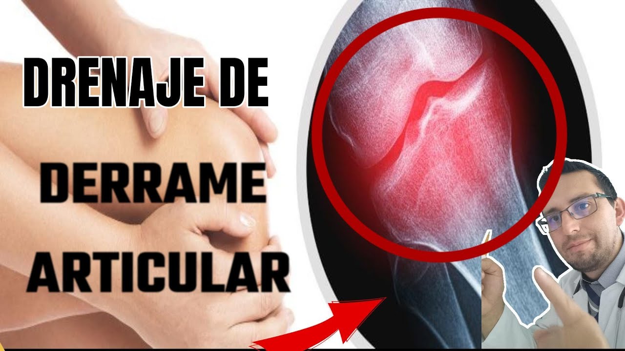 dolor-de-rodilla-drenaje-de-derrame-articular-de-rodilla-youtube