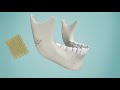 Resorbable Ceramic Biocomposites for Orthpaedic and Maxillofacial Applications