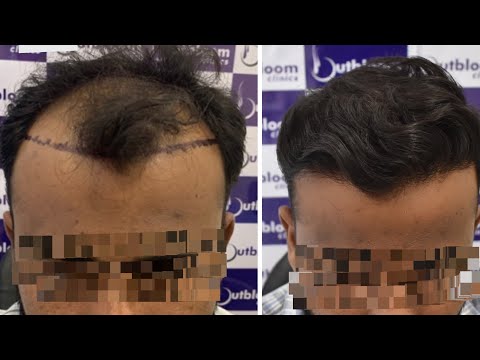 Hairtransplantinindia #besthairtransplant #fuehairtransplant