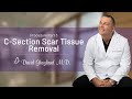 Csection scar tissue removal  procedure part 3  david ghozland md