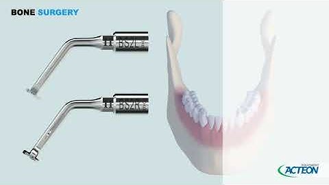 PIEZOTOME® Crest Splitting 3D Protocol
