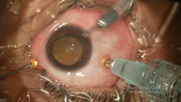 Diabetic Tractional Retinal Detachment | Vitrector Assisted Segmentation