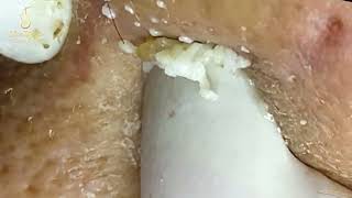 Loan Nguyen Acne Treatment 1441mh