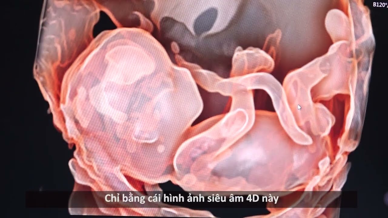 Máy Siêu Âm 5D: Bước Tiến Trong Chăm Sóc Thai Nhi