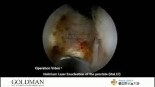 Holmium Laser Enucleation - Goldman Urology Clinic