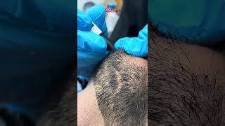 Permanent White Hair Removal Journey with Electrolysis #skincare #plasticandbeauty #laserhairremoval