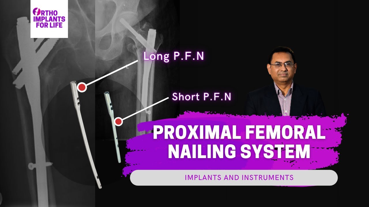 Canwell Proximal Femoral Nail, Implant and Instrument - China Intertan Nail,  Pfna Nail | Made-in-China.com