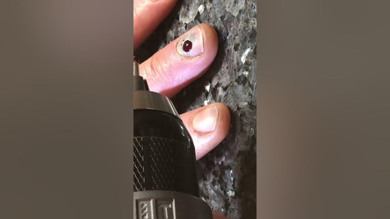 how-to-relieve-pressure-pain-under-a-smashed-fingernail-fast-quick
