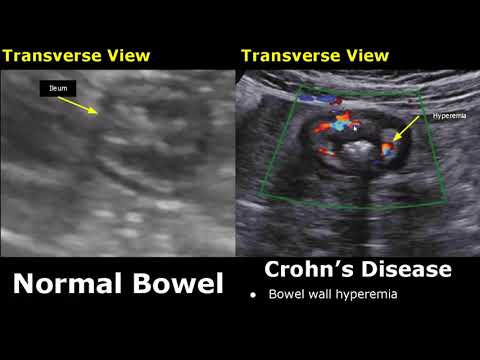 Small Bowel Ultrasound