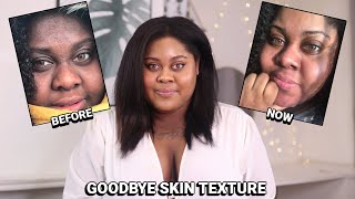 TRETINOIN UPDATE - Goodbye Textured Skin Hyperpigmentation Tretinoin Before And After