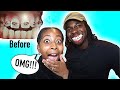 I FINALLY GOT MY BRACES REMOVED AFTER 2 YEARS!!!  *Crazy Transformation!!* (Before/After Pictures)