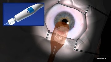 EndoSerter® Corneal Endothelium Delivery Instrument Instructional Video (May 2012) Short Version