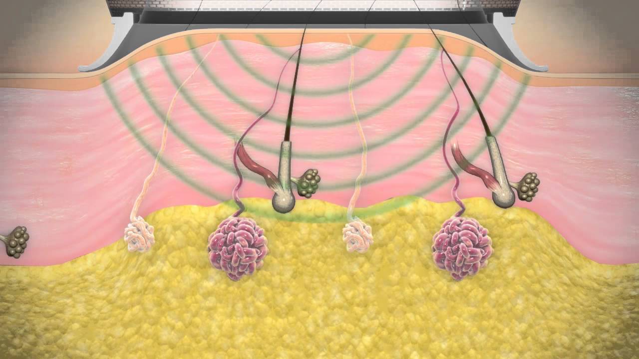 MiraDry® treatment for excessive underarm sweating - Dr Malcolm Rude