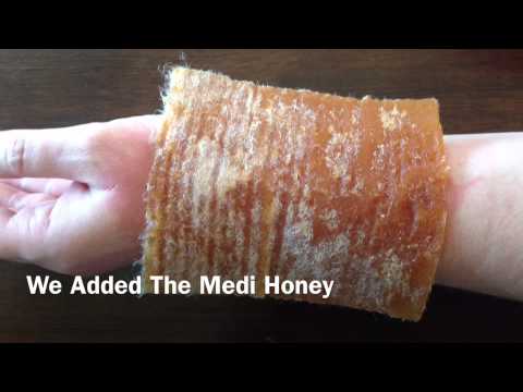 Video: 10 Consigli Su Honey For Burns