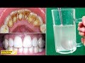 Eliminar La Placa Dental Y El Sarro Rápidamente Sólo Con Estos 3 Ingredientes Naturales