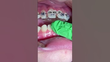 Gắn mắc cài cận cảnh - niềng răng không đau #rang #nhakhoa