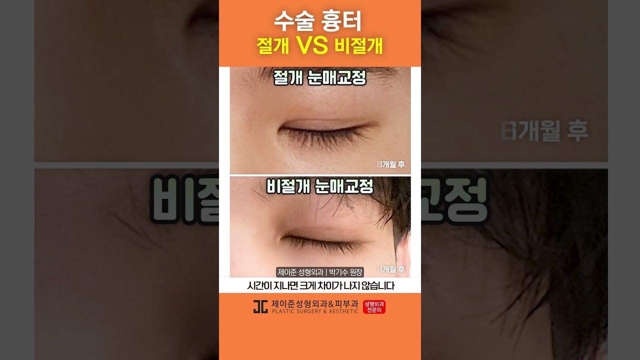 [JAYJUN PHẪU THUẬT THẨM MỸ DA] Cắt hay không cắt? Đừng lo lắng về sẹo hai mí nữa nhé~ #shorts