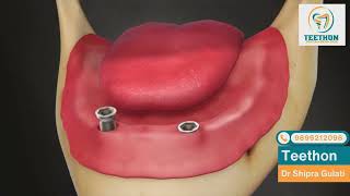 Implant two implants with denture and precision bar