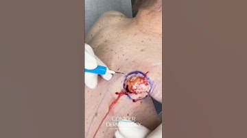 Back Lump REVEALED: Watch This Satisfying Cyst REMOVAL! | CONTOUR DERMATOLOGY