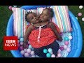 What is the future for these conjoined twins? - BBC News