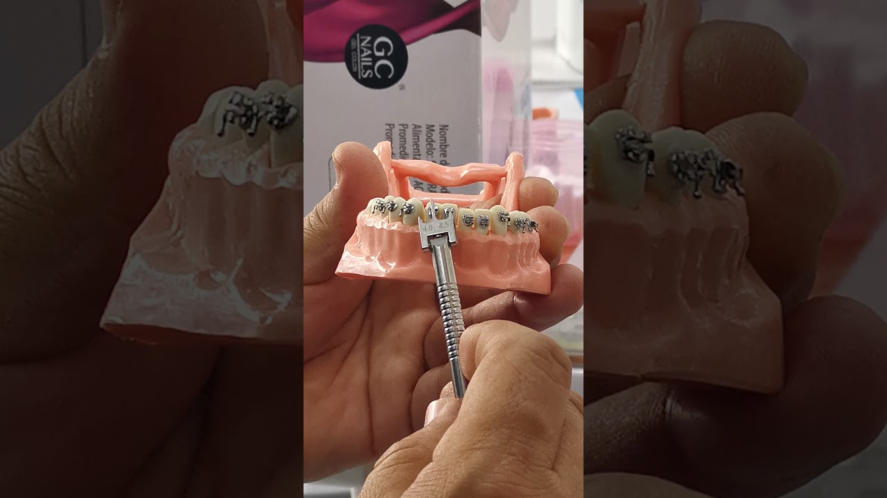 Como poner brackets para Drs