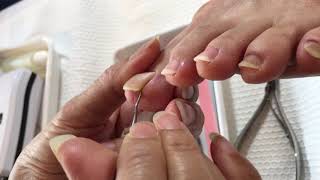 足の爪の角チェックとごみ取り【爪垢掃除・除去】cleaning the dart under toenails