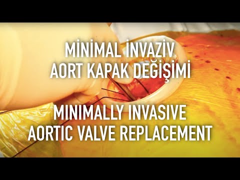 Minimal İnvaziv Teknikle Aort Kapak Değişimi | Minimally Invasive Aortic Valve Replacement