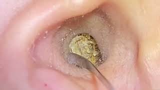 ASMR Ear Cleaning: Shocking Truth About Safe Wax Removal