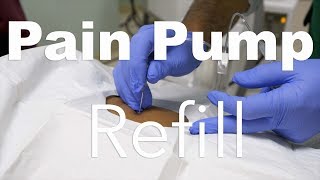 Behind The Scenes Intrathecal Pain Pump Refill