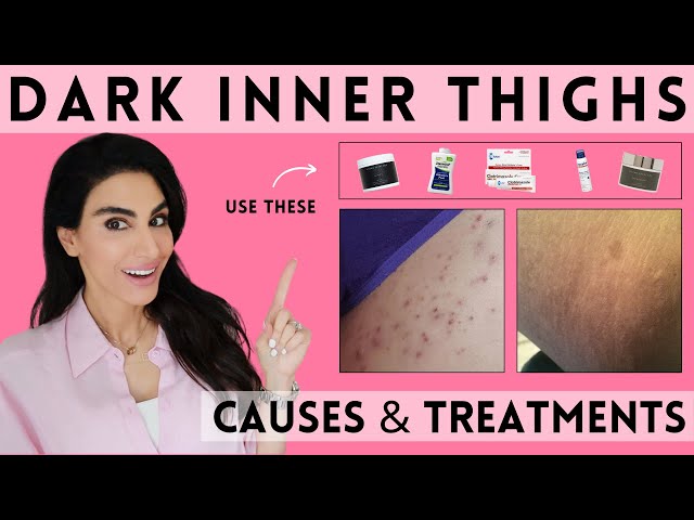 Best Ways to Lighten Dark Inner Thighs