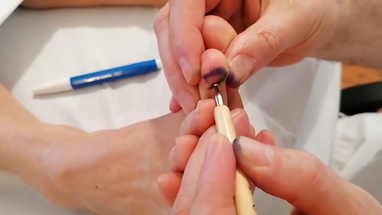 Foot Reflexology : Broca Area reflex -  Central nervous system (CNS)