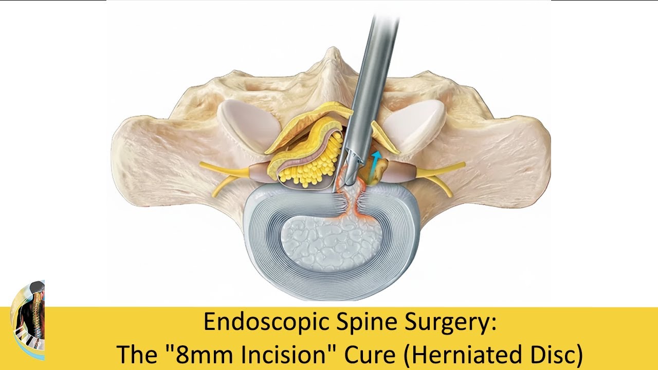 Эндоскопия позвоночника: Разрез всего 8 мм (Грыжа диска)