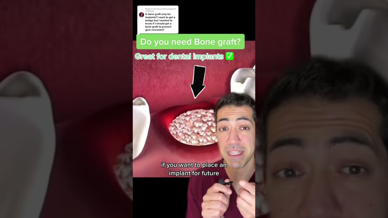 Do you need a bone graft to replace a missing tooth with a dental bridge? How about a dental implant