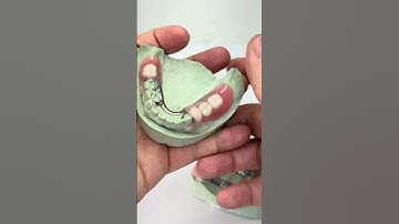 Clear clasps from Metal partial!