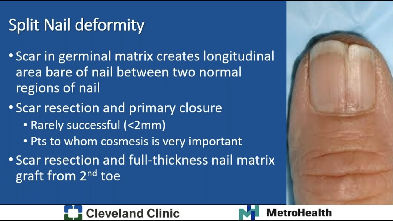 Excision of Nailbed Remnant following Finger Amputation | CSurgeries