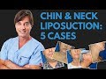 Liposuction for a Double Chin: 5 Cases with Before & After Photos