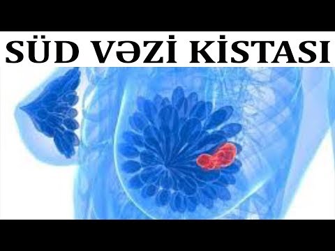 Video: Kistlər öz-özünə yox olacaqmı?