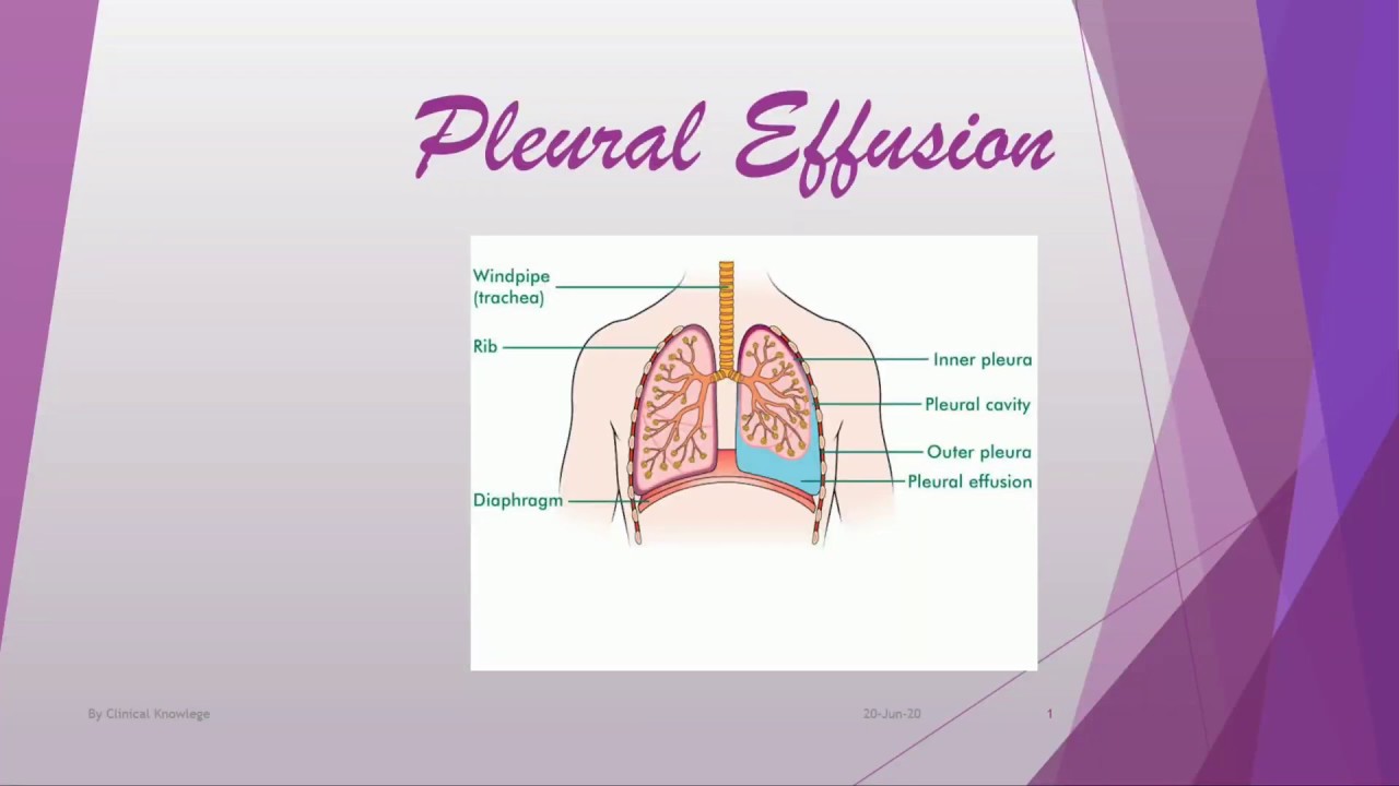 Pleural Effusion Definition, Causes, Signs and Symptoms