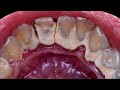 21 yo females teeth  tartar removal  scaling  dentist  dokter gigi tri putra