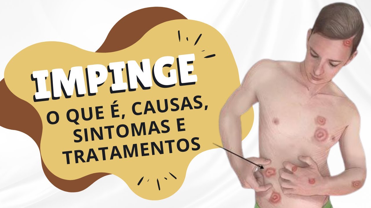 Impinge - o que é, causas, sintomas e tratamentos - YouTube