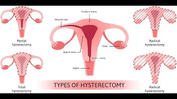Hysterectomy after cesarean CPT code - simplify medical coding