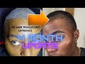 My Hair Transplant! 4 MONTH UPDATE! + Q&A! | Asli Tarcan Hair Clinic Istanbul |ThePlasticboy