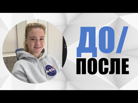 # 9 Случай до/после. Ортодонтическое лечение мезиального прикуса с обратным перекрытием.