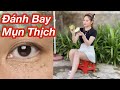 Mụn Cơm, Mụn Thịch Biến Khỏi Cơ Thể Bạn Nếu Làm Theo Cách Này/ Cách Trị Mụn Thịch Mụn Cơm Siêu Nhanh