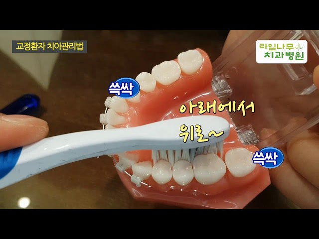 [라임나무치과병원]치아교정 중 치아관리는 어떻게?