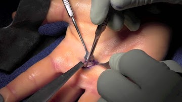 Trigger Finger Release