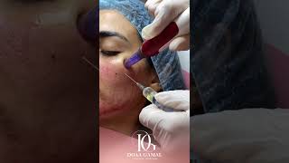 ديرما بن لعلاج جميع مشاكل بشرتك بخصم 50% مع عيادات دكتورة دعاء جمال | Dr Doaa Gamal Clinics