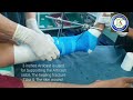 External fixator removal  tibial exfix removal  articast plastering leg fractures  adamya hsp vd