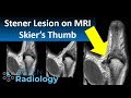 Stener Lesion (Skier's Thumb) on MRI