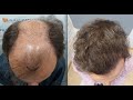 5202 Grafts. Hair Transplant by FUE Technique. Advanced Alopecia. 1148/2013